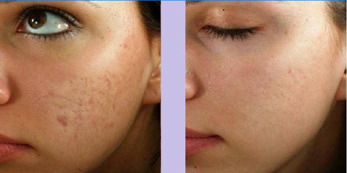 O rosto da mulher antes e depois da massagem
