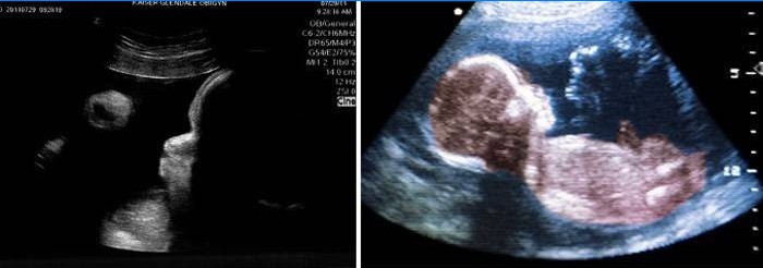 Ultra-sonografia do abdome com 39 semanas de gestação