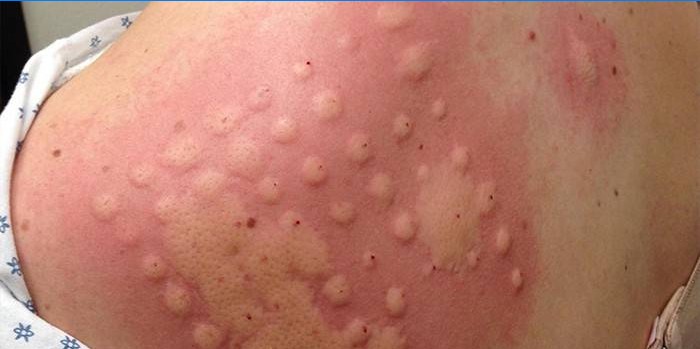Teste alérgico da pele