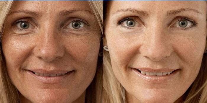 Foto de uma mulher antes e depois da biorevitalização