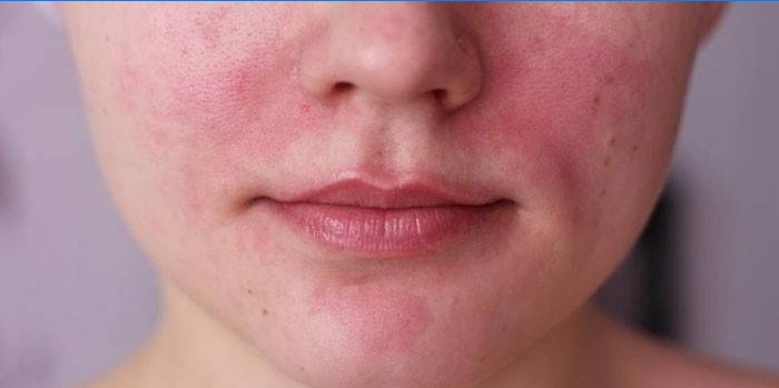A manifestação de uma alergia no rosto