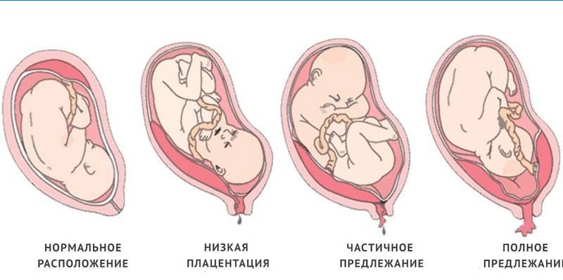 Tipos de placenta prévia