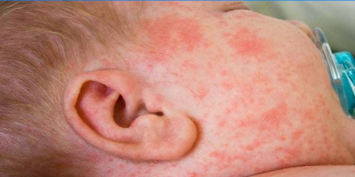 Erupção alérgica no rosto da criança