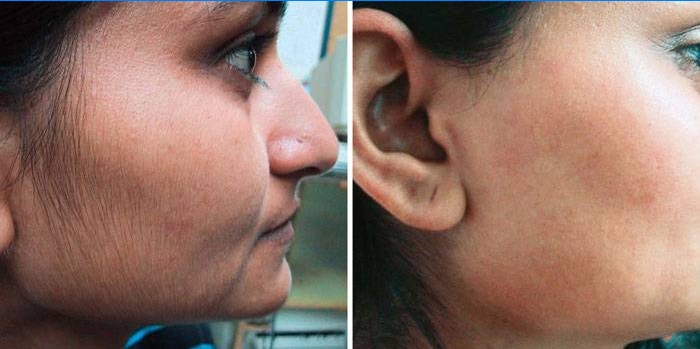 Depilação a laser no rosto: fotos antes e depois